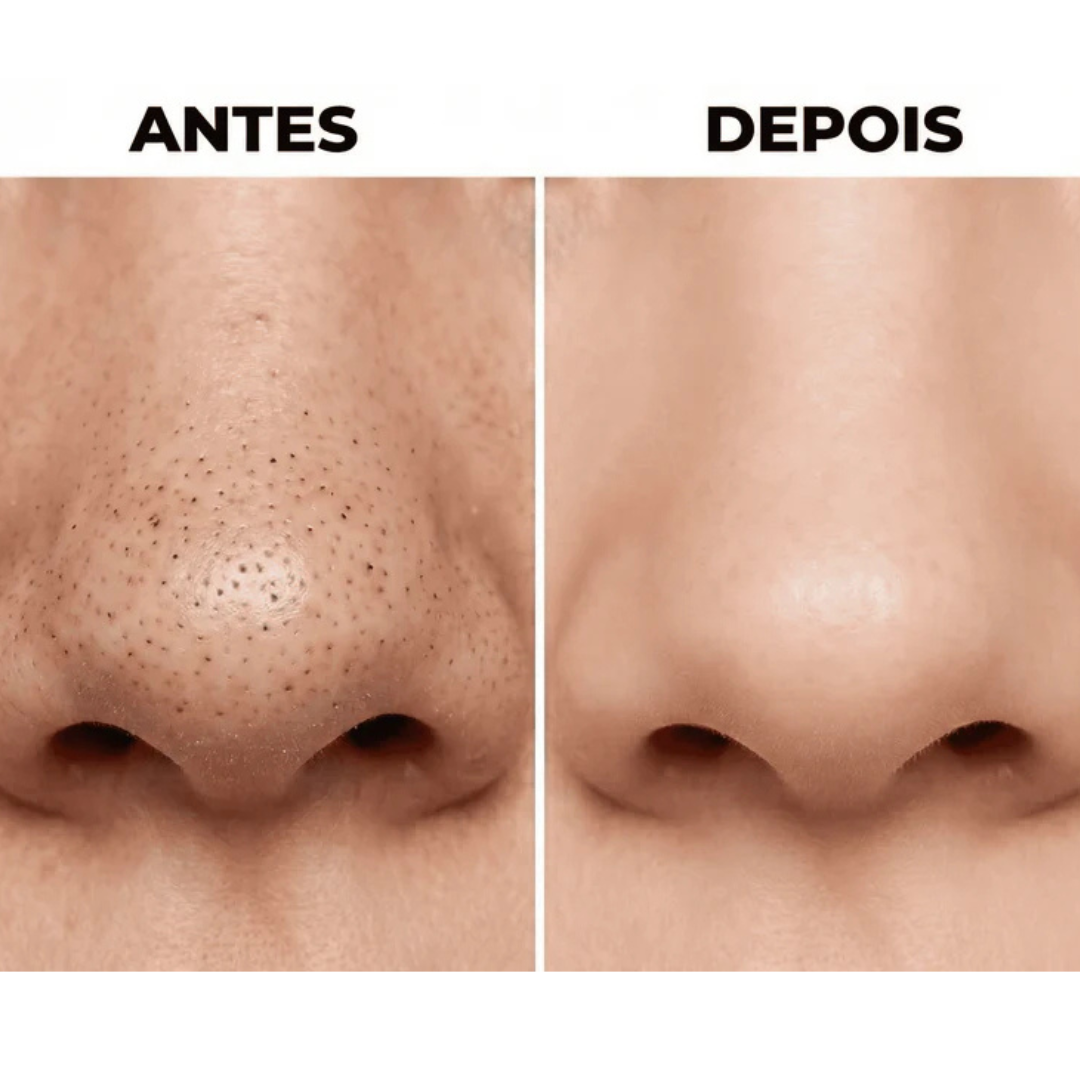 Extrator Derma Skin - Limpeza de Poros